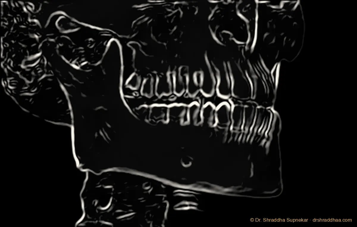 Line-drawing anatomy plate rendered from an anonymised CBCT volume, lateral view of the jaws and skull base, with the mandible, ramus, condyle, maxilla, zygomatic arch, occlusal plane, mental foramen and cervical vertebrae labelled